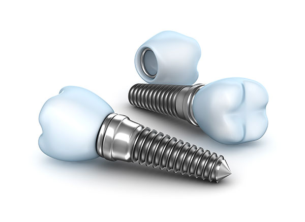 Dental Implants Anchorage