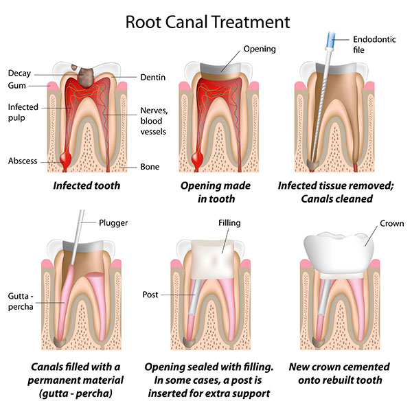 Root Canal Treatment Anchorage